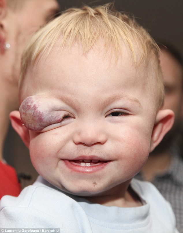 6-month-old undergoes successful surgery to remove rare birthmark that put eyesight at risk
